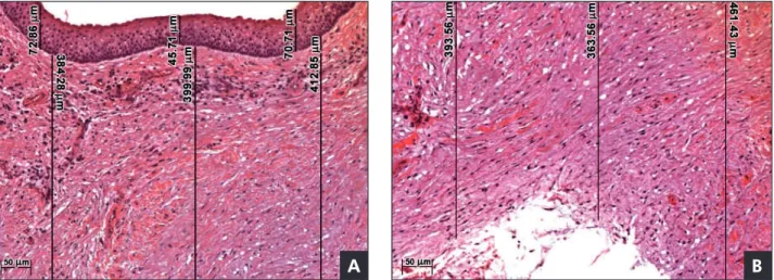 Figure 1 - Keratocystic odontogenic tumor specimen before marsupialization. A: The epithelial lining is represented by parake- parake-ratinized stratified squamous epithelium with few layers and a basal palisade layer with cubic or columnar cells and  hype
