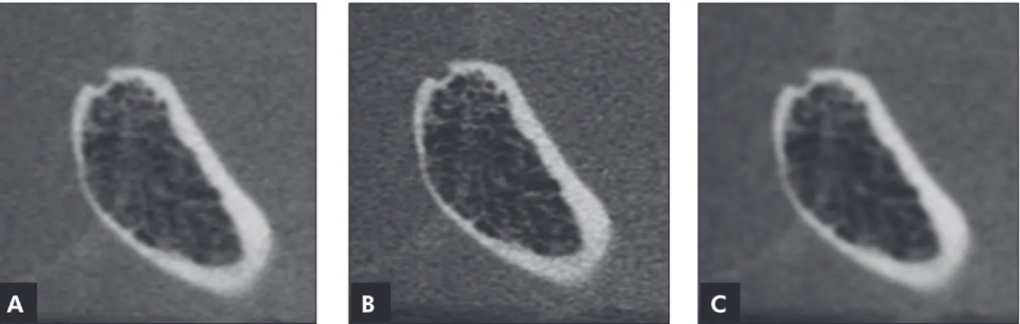 Figure 2 - Cross-sectional slices of the condyle in Figure 1 reconstructed in protocols 1, 2 and 3: (A) 0.2 mm-thick section and  no filter; (B) 0.2 mm-thick section and Sharpen Mild filter; (C) 0.2 mm-thick section and S9 filter.