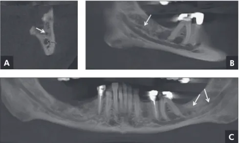 Figure 1 - Unilateral bifurcation (right  side) extending to the region of the  third molar and adjacent structures  (Type 1U)