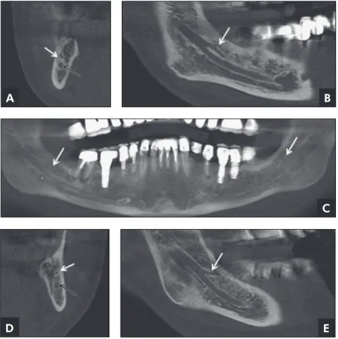 Figure 4 - Combination of the first two  categories (Type 3). Right axial cut (A)  and lateral view (B) of the bifurcation  extending through the mandibular  body (Type 2)