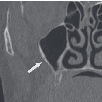 Figure 4 - Coronal view of the maxillary sinus reveals the  artery  (arrow),  which  is  on  the  outer  cortex  of  the  lateral  sinus wall.