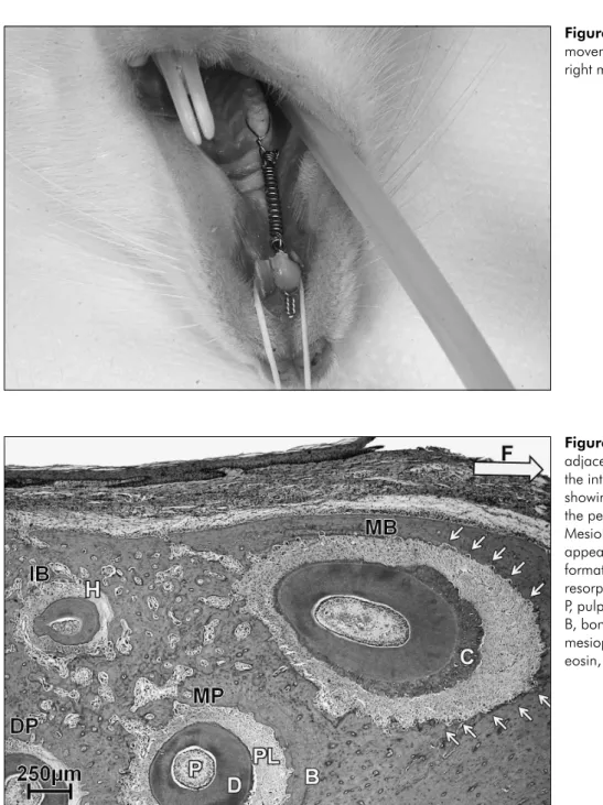Figure 1 - Orthodontic tooth  movement device on the maxillary  right molar, anchored to the incisor.