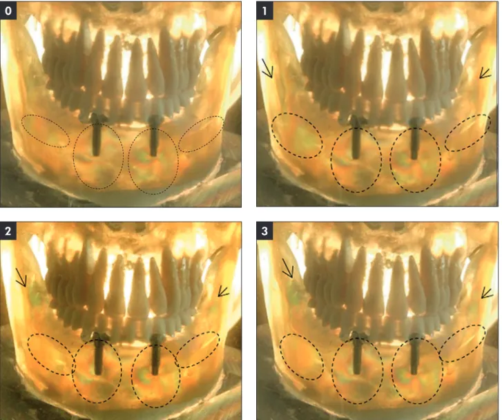 Figure 2 - PAPI: Bar-clip overdenture on two parallel implants, followed by load application.