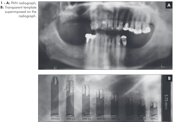 Figure 1 - A: PAN radiograph;  B: Transparent template  superimposed on the   radiograph