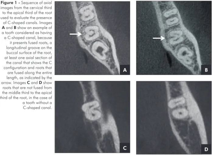 Figure 1 - Sequence of axial  images from the cervical third  to the apical third of the root  used to evaluate the presence  of C-shaped canals