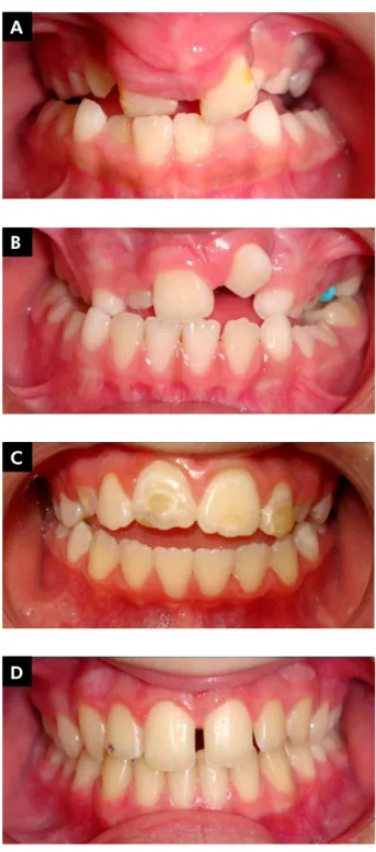 Figure 1A); Group 2 - with CLP and without ED (n 