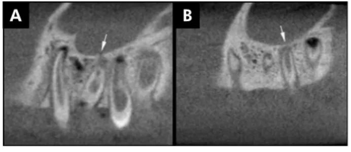 Figure 2. Coronal CBCT images: A) Sample with oroantral com- com-munication (arrow) caused by periapical lesion; B) Sample without  disruption of cortical sinus (arrow) close to periapical lesion.