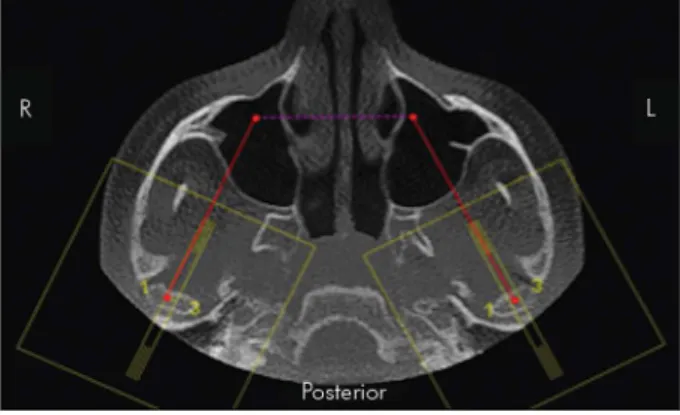 Figure 1. Sagittal view of the TMJ to perform the axial cuts.