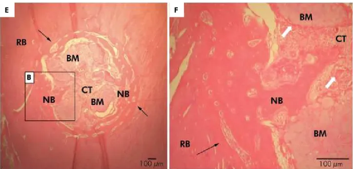 Figure 5. Representative photomicrographs of the SrHA group. Defect area (black arrow); newly formed bone (NB); central area  of the defect composed of loose connective tissue (CT) with sparse chronic inflammatory infiltrate and multinucleated giant cells 
