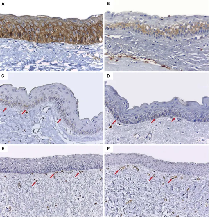 Figure 1. A) Epithelial immunoexpression of GLUT-1 in more than 76% of cells (score 4) in SKOT (Advance, 400×)