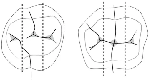 Figure 2. Schematic illustration of the division of the occlusal surfaces of first permanent molars into three sections