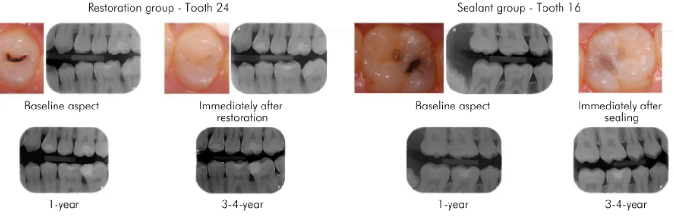 Figure 3. Clinical and radiographic images of teeth allocated to the test and the control groups (baseline and 3–4-year follow-up).