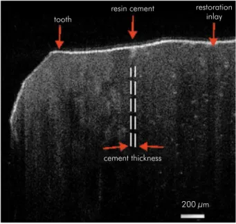 Figure 5. A representative transversal view of internal  adaptation of ceramic inlay was measured through optical  scan of internal resin cement.