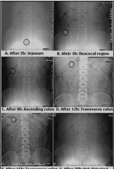 FIGURE 4  - The X-ray images at different time points showing  tablet formulation CLH63 localization in the gastrointestinal  tract.