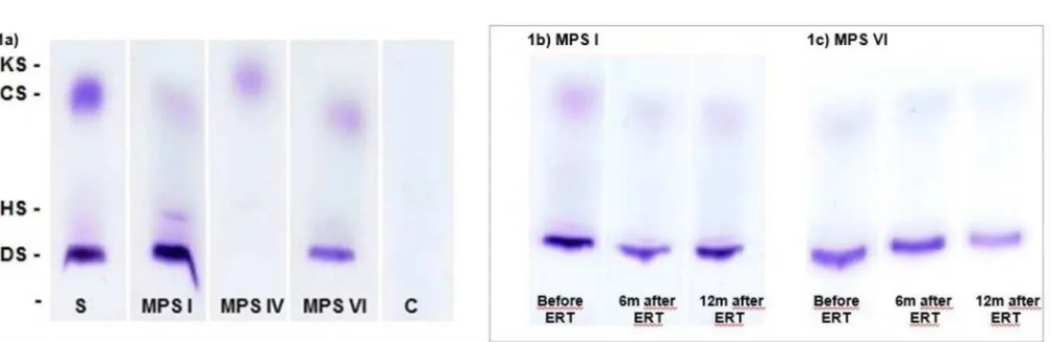 Figure 1b shows electrophoresis of urine samples  from patients with MPS and the pattern of the accumulated  GAGs bands over time (before and 6 and 12 months after  ERT initiation).