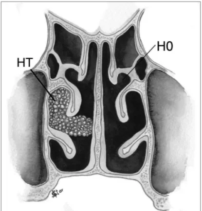 Figure 2. NP staging in the horizontal plane - H0 - No polyps. HT -  Polyps extending beyond the middle meatus and touching the septum