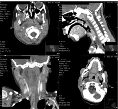 Figure 1. A. Latero and Retropharyngeal abscess (CT scan, axial view). 