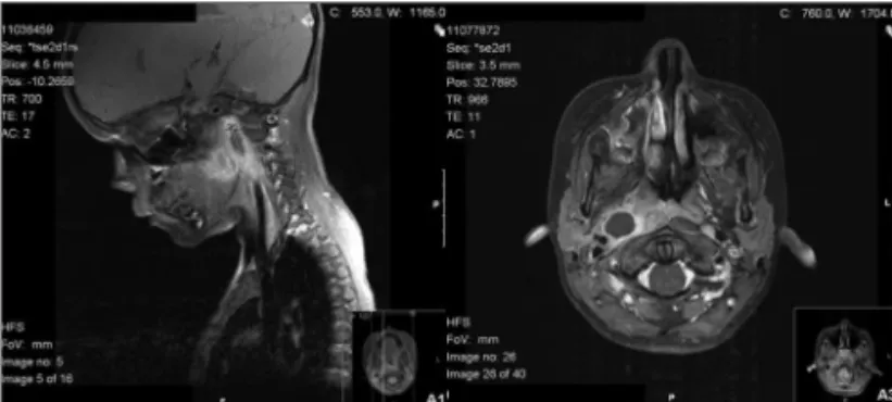 Figure 2. A. Lateropharyngeal abscess (MRI scan, sagittal view). B. 