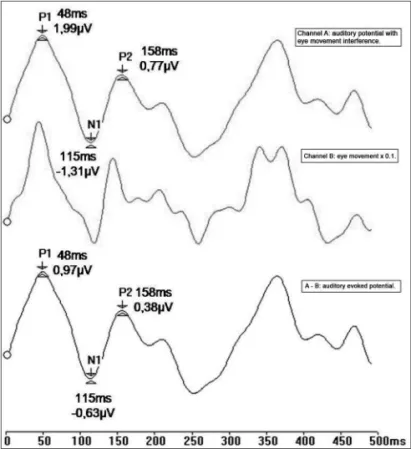 Figure 2. Recording of long latency auditory evoked potentials by the  ocular artifact subtraction method (ms - milliseconds, mV - microvolt).