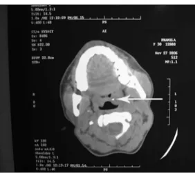 Figure 1. CT scan showing a small metallic density in left  tonsil(arrow)