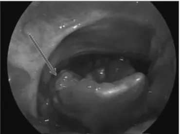 Figure  4.  Atypical  aphthous  lesion  in  the  lingual  face  of  the  right  epiglottis.