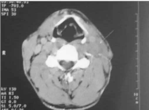 Figure 1. Enlarged conglomerate of cervical lymph nodes along  the left jugular vein.