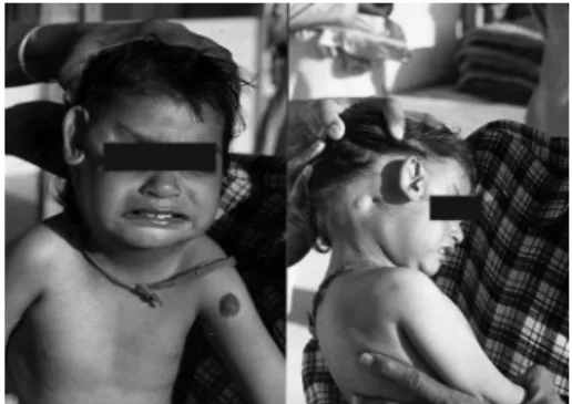 Figure  1.  Ectopic  Pinna  -  Right  Pinna,  displaced  towards  the  lateral canthus of the Right eye