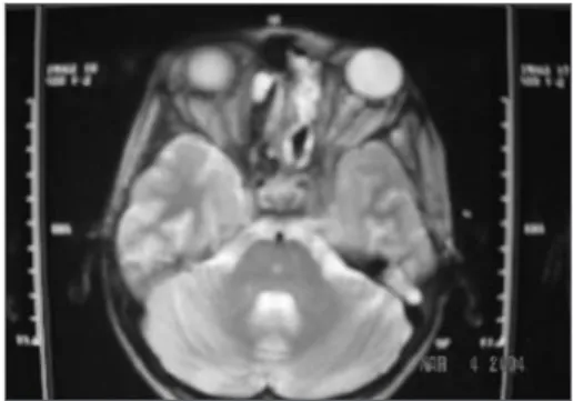 Figure 1. Soft tissue tumor occupying the left nasal cavity and  invading the cavernous sinus.