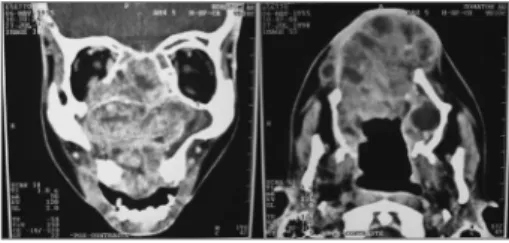 Figure 1. CT scan showing a large solid mass occupying part of  the right-side maxillary sinus, palate and nasal cavity.