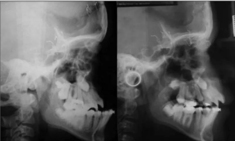 Figure 1. Lateral teleradiograph of a patient undergoing a Le Fort III type  osteotomy followed by midface distraction osteogenesis with a rigid  external device (RED)