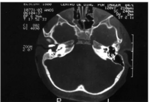 Figure 1. Axial view of a temporal bone CT scan: tapering exter- exter-nal ear caexter-nal atresia, not reaching what would be the tympanic  membranes