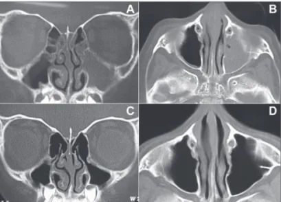 Figure 3. Pre and post-operative CT scan (exam carried out 6 months  after the surgery) from a patient submitted to sinuplasty