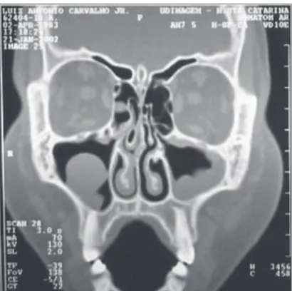 Table 1. Number of affected paranasal sinuses in pre- and post-HSCT computed tomography
