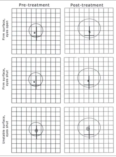 Figure 2. Balance Rehabilitation Unit posturography, in the elderly  with BPPV, before and after Epley’s maneuver on the situations of firm  surface with eyes open and closed and firm surface with eyes shut