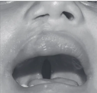 Figure 2. Patient with incomplete left-side cleft lip associated with  incomplete cleft palate.