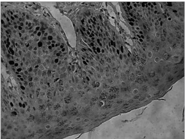 Figure 1. CK 16 expression on the suprabasal layers of the normal  external auditory meatus (source: Morphology Department - Medical  Sciences School - Santa Casa de São Paulo).