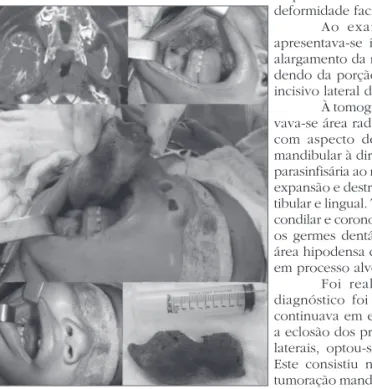 Figura 1. Mixoma Maxilo-Mandibular. Conjunto fotográfico  ilustrando o aspecto tomográfico e macroscópico da lesão e a  exérese da hemimandíbula direita.