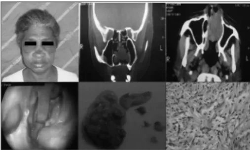 Figure  1.  Set  of  photographs  from  this  patient,  CT  scan,  late  post-op, macroscopy and microscopy of the lesion.