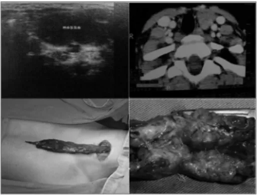 Figure 1. Ultrasound image of a cystic mass in the left cervical  region,  suggesting  a  branchial  cyst;  computed  tomographic  image showing a solid lesion in the parathyroid region, deviating  the  trachea  to  the  right,  suggesting  a  lymphoma