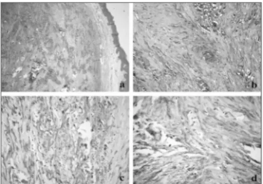 Figura  1.  (a)  Lesão  separada  do  epitélio  de  revestimento  da  mucosa  oral  por  faixa  de  tecido  conjuntivo  fibroso,  exibindo  ainda extensas áreas de calcificação (HE/ 40x); (b) detalhe das  calcificações dispersas entre os feixes de células 