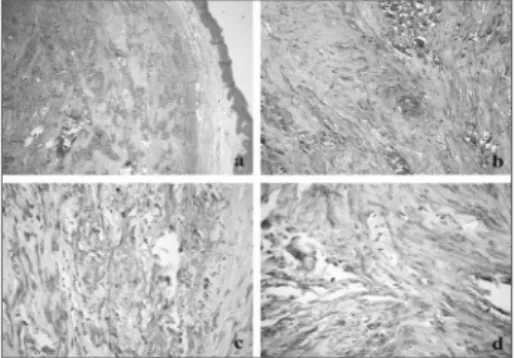 Figure 1. (a) Lesion separated from the oral mucosal coating by  a band of fibrous connective tissue, showing extensive areas of  calcification (HE/ 40x); (b) details of the calcification areas spread  among the bundles of spindle-shaped cells (HE/ 200x); 