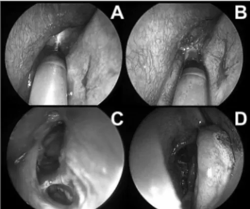 Figure 1. Right frontal sinus sinuplasty. A: endoscopic view (45  degrees, 4mm) of the right middle meatus and placement of a  guide  wire  in  the  right  frontal  sinus  under  transillumination