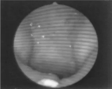 Figure 6. Patient3: VPS closure in basal register