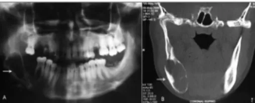 Figure  1.  Lytic  insuflating  lesion  with  regular  borders  and  fine  internal  septations,  located  in  the  right  mandibular  body