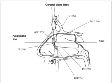 Figure 4. Representative drawing of the sites where the transillumina- transillumina-tion point was found and its respective frequencies.