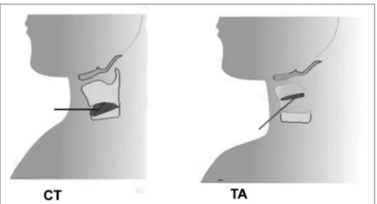 Figure 1. Electrode insertion in CT (cricothyroid) and TA (thyroaryte- (thyroaryte-noid) muscles