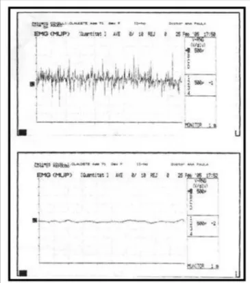 Figure 2. Normal laryngeal electromyography tracing during phonation  (above) and rest (below).