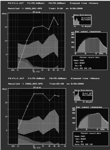 Figure 1 shows an example of present distortion product  otoacoustic  emissions  before  and  after  treatment  for  Group 3 and also observed in all other studied groups