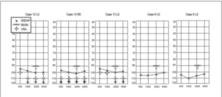 Figure 2. Examples of cases comparing the click-BERA and the SSE- SSE-AP II. - SSESSE-AP: Steady State Evoked Auditory Potentials; Click-BERA: 