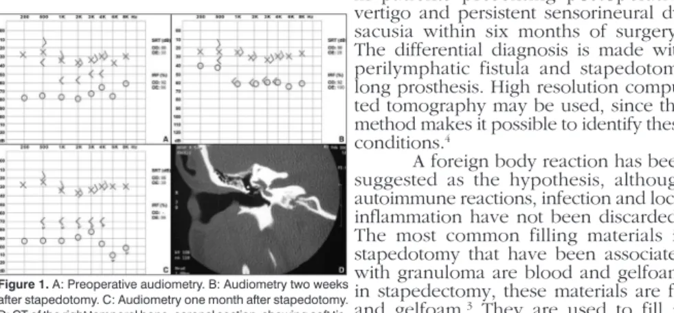Figure 1. A: Preoperative audiometry. B: Audiometry two weeks  after stapedotomy. C: Audiometry one month after stapedotomy